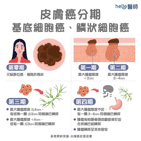 長毛痣|皮膚長痣、長斑是皮膚癌前兆？皮膚癌初期4大症狀快。